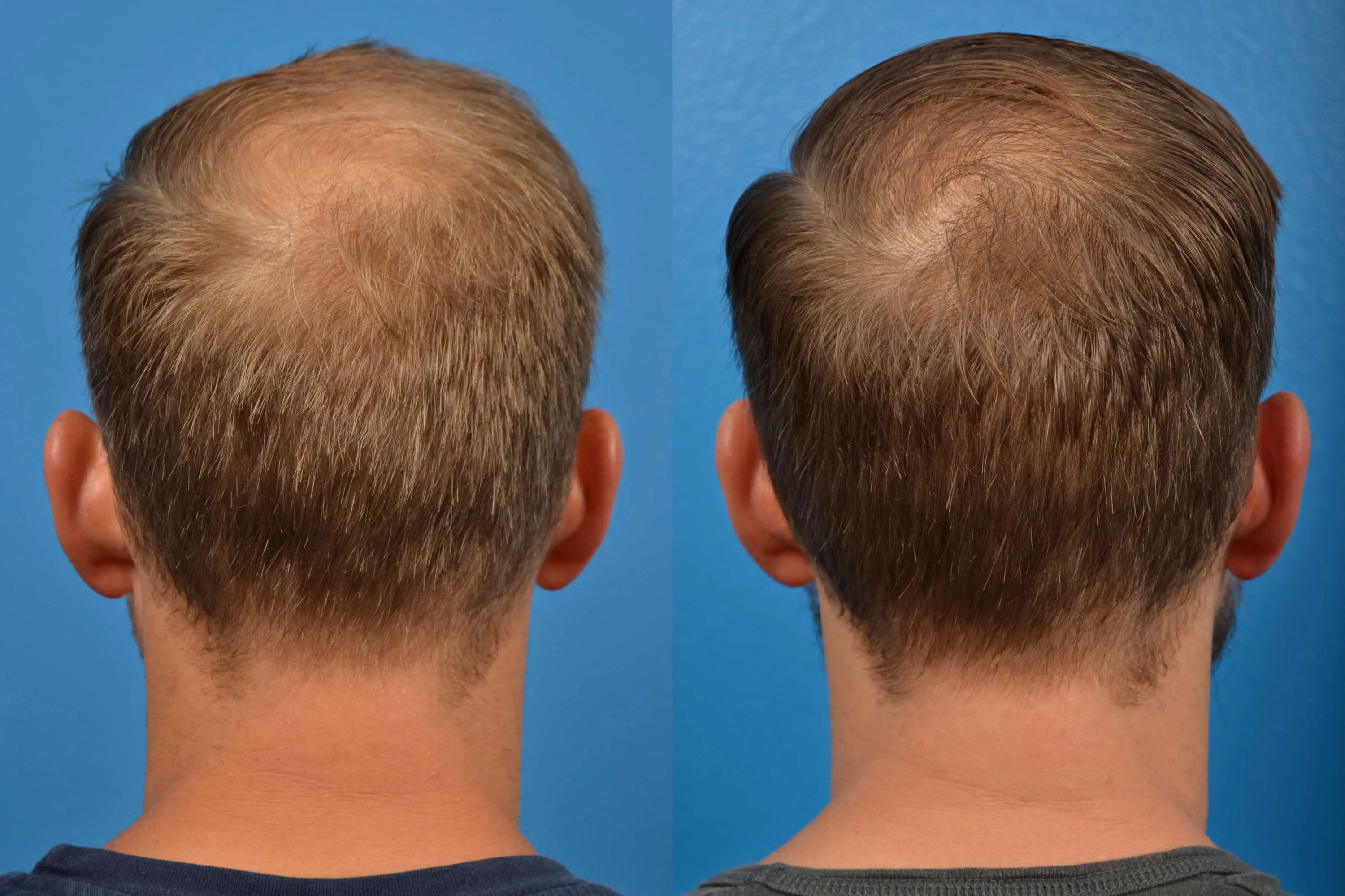 The Hair Restoration Revolution